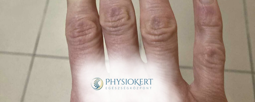 Raynaud-szindróma és a hideg idő miért dermednek meg és színeződnek el az ujjak Physiokert Egészségközpont