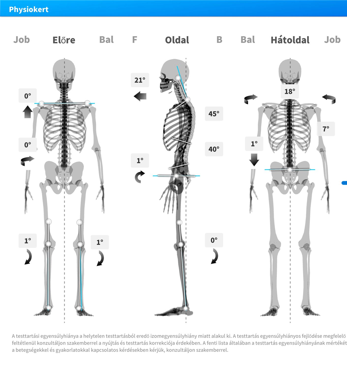 Moti Physio testtartás-elemzés — csontváz három nézetből, szögadatokkal